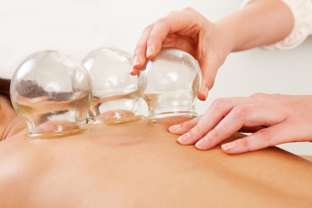 Detail of an acupuncture therapist removing a glass globe in a f